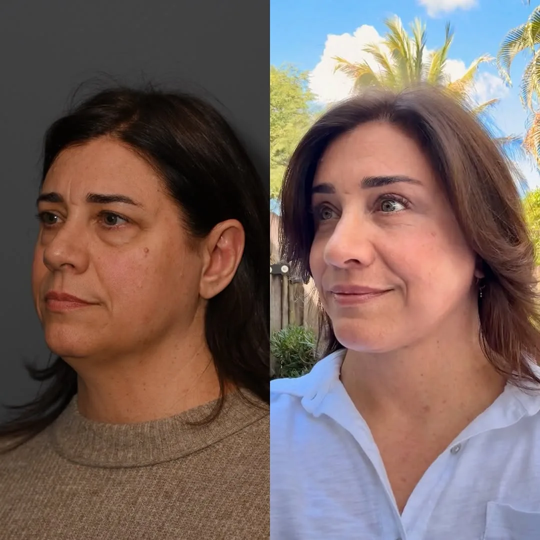 Before and after deep plane facelift — 57-year-old woman, three-quarter view, 3mo post-op by Dr. Sean Alemi