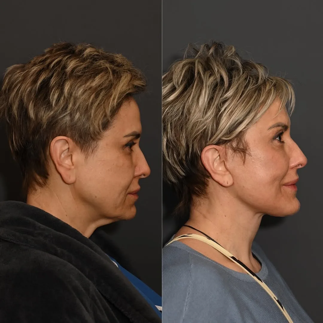 Before and after deep plane facelift — 57-year-old woman, right profile view, 3mo post-op by Dr. Sean Alemi