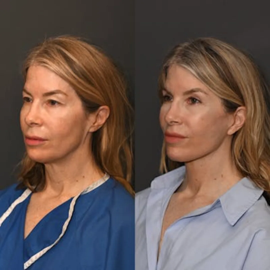 Before and after deep plane facelift — 45-year-old woman, oblique left view, 7mo post-op by Dr. Sean Alemi