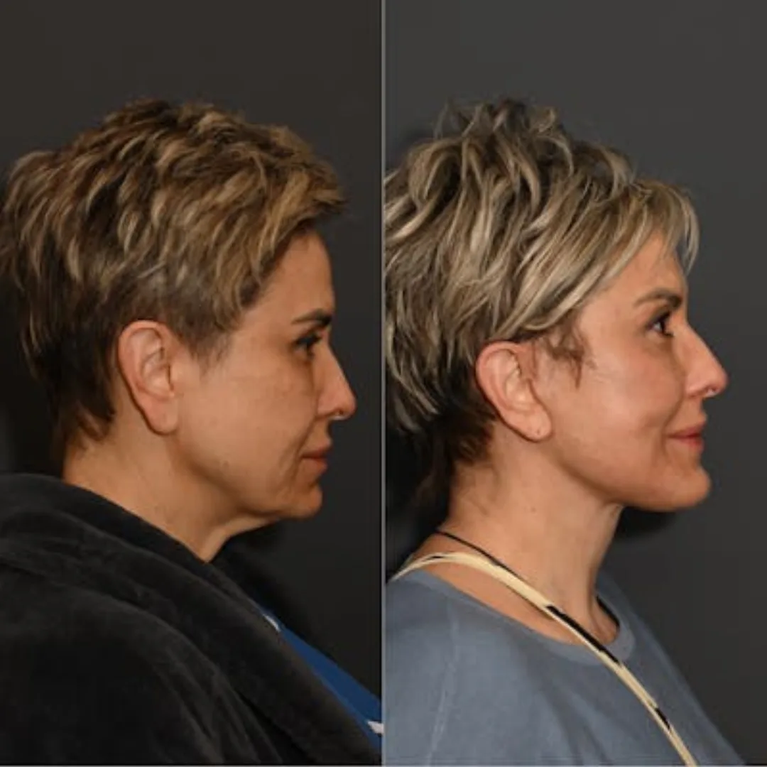 Before and after deep plane facelift — 45-year-old woman, right profile view, 6mo post-op by Dr. Sean Alemi
