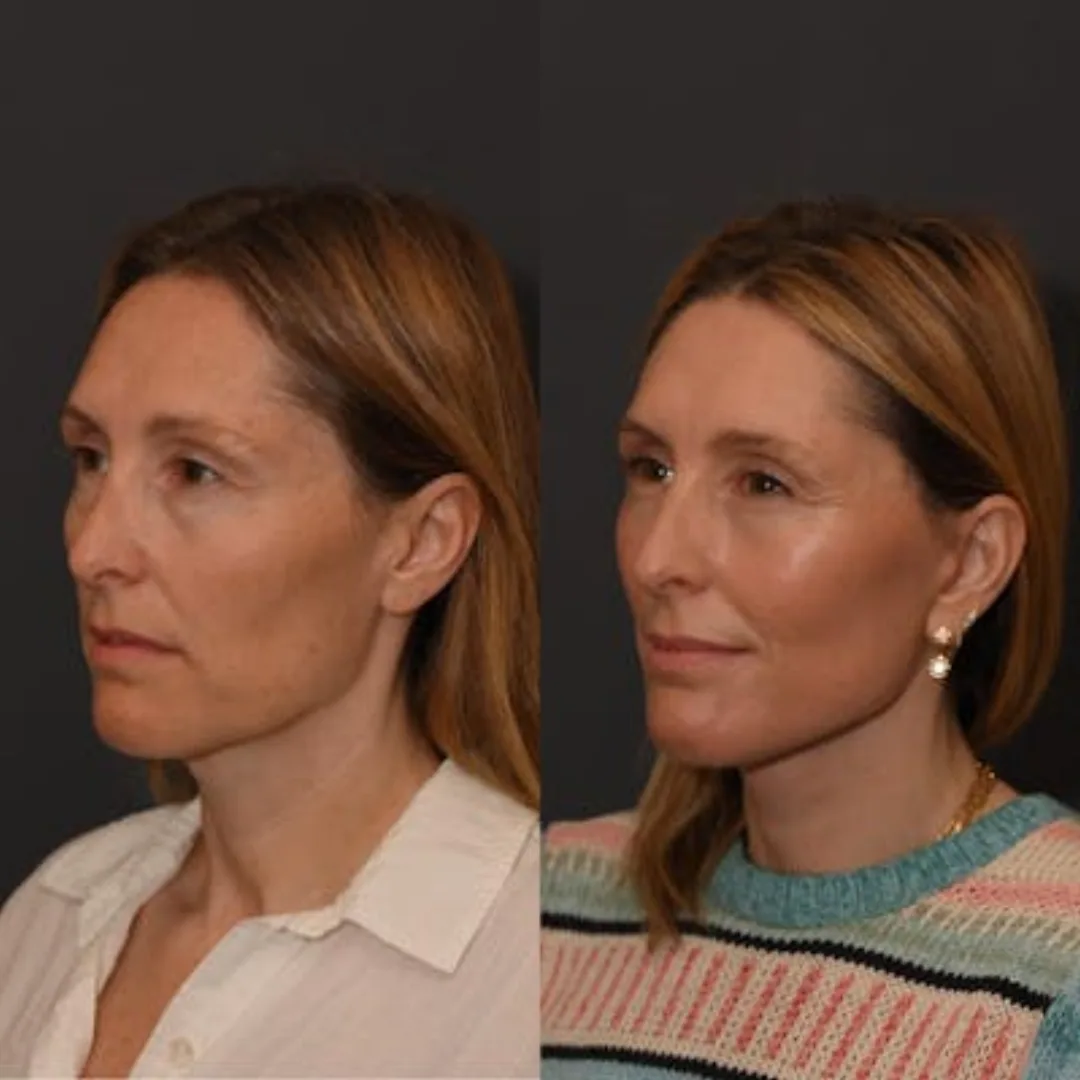 Before and after deep plane facelift — 48-year-old woman, left profile view, 6mo post-op by Dr. Sean Alemi