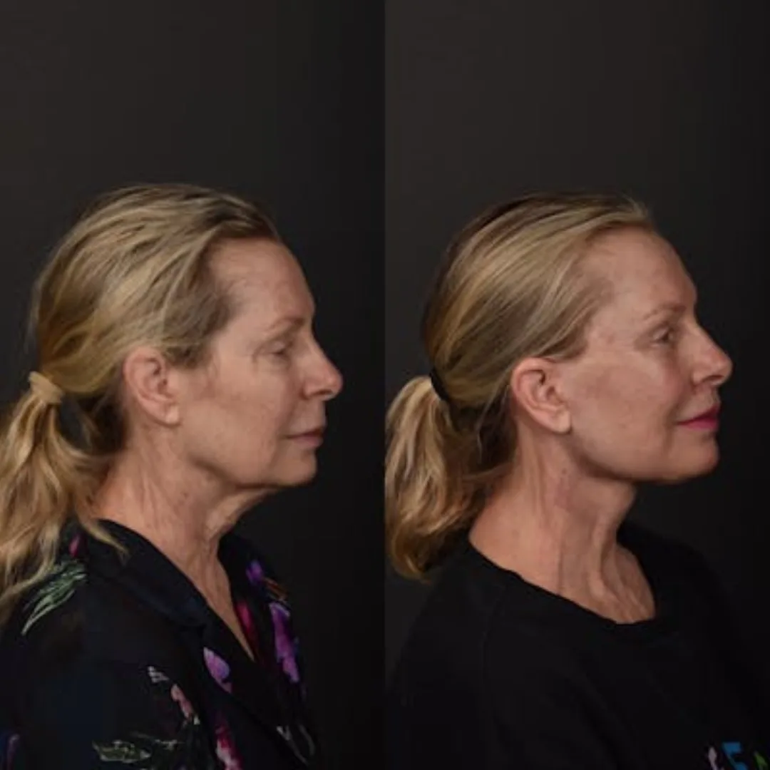 Before and after deep plane facelift — 55-year-old woman, right profile view, 6mo post-op by Dr. Sean Alemi