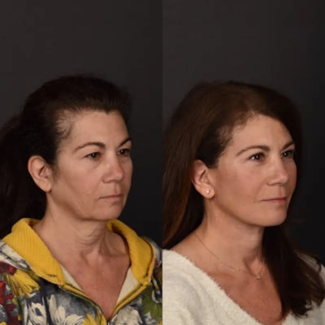 Before and after deep plane facelift — 48-year-old woman, oblique right view, 6mo post-op by Dr. Sean Alemi