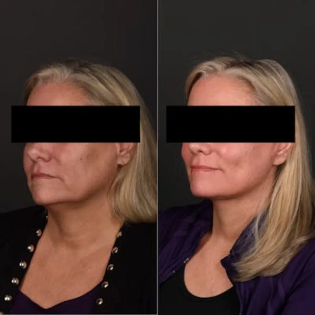 Before and after deep plane facelift — 55-year-old woman, oblique right view, 6mo post-op by Dr. Sean Alemi