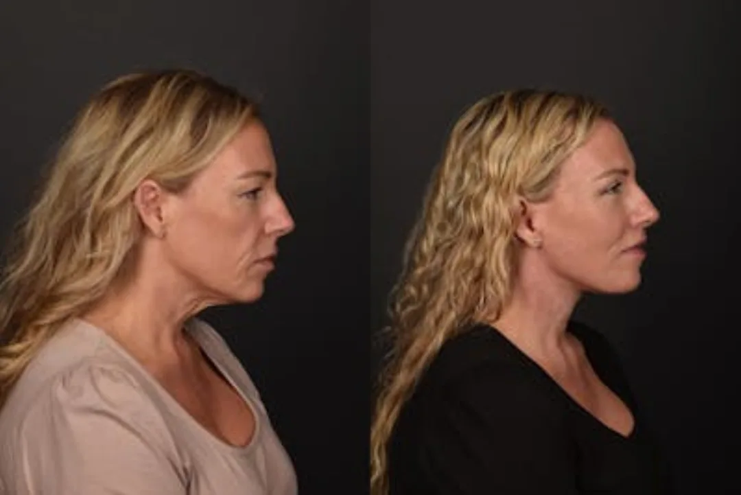 Before and after deep plane facelift — 52-year-old woman, right profile view, 6mo post-op by Dr. Sean Alemi