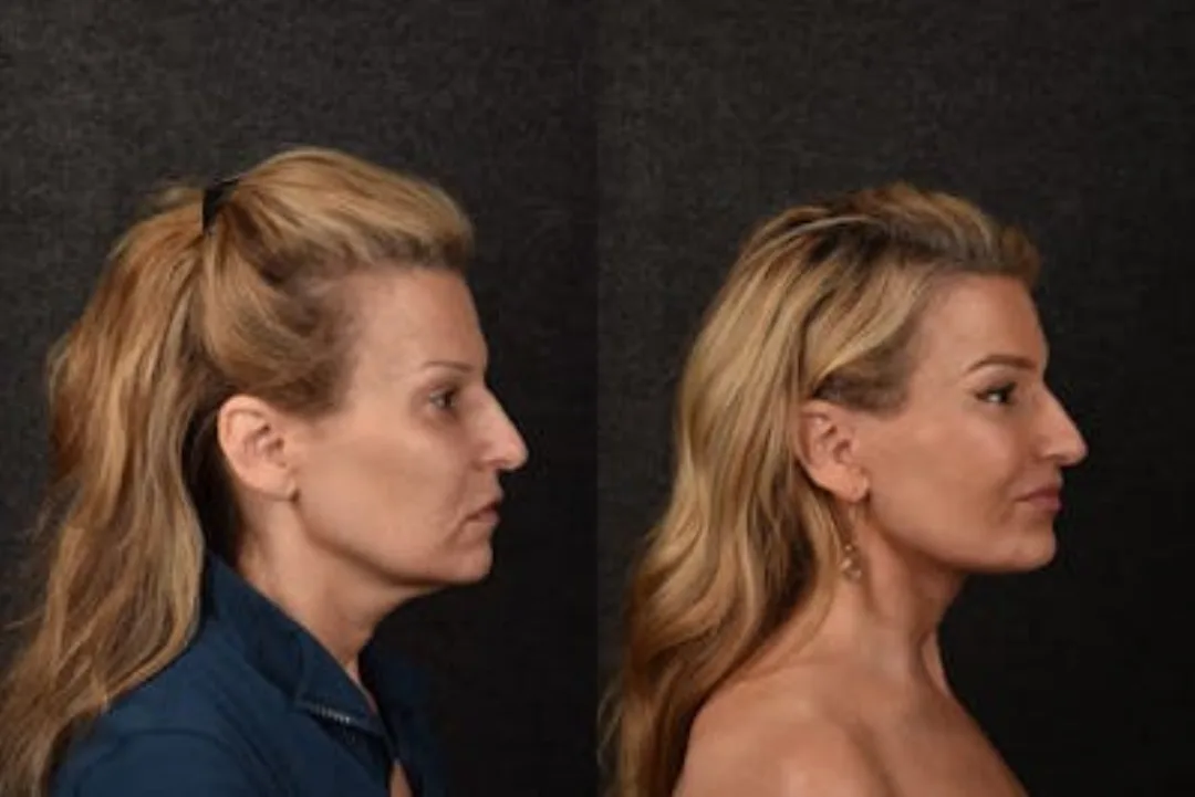 Before and after deep plane facelift — 45-year-old woman, right profile view, 6mo post-op by Dr. Sean Alemi