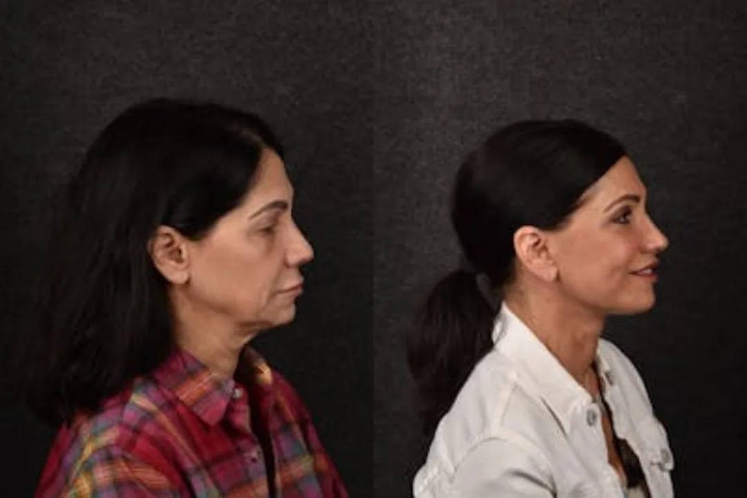 Before and after deep plane facelift — 45-year-old woman, right profile view, 6mo post-op by Dr. Sean Alemi