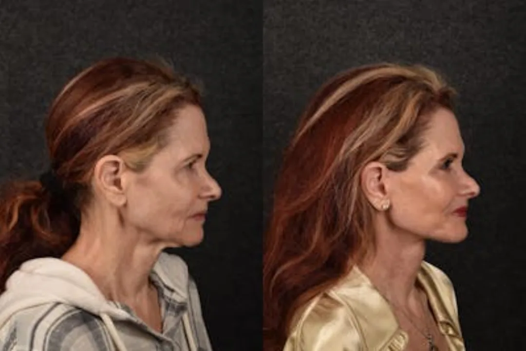 Before and after deep plane facelift — 48-year-old woman, right profile view, 6mo post-op by Dr. Sean Alemi