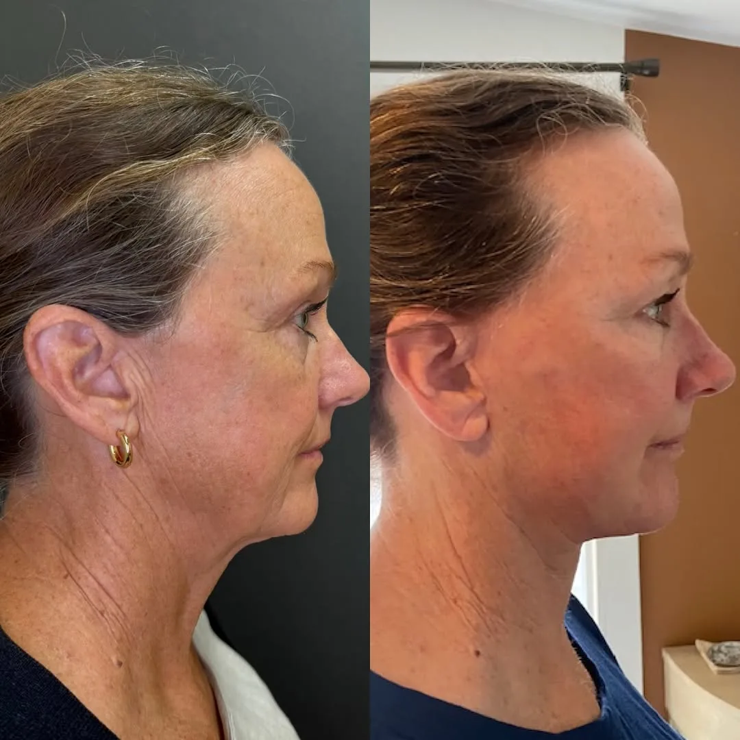 Before and after deep plane facelift — 55-year-old woman, right profile view, 6mo post-op by Dr. Sean Hashemi