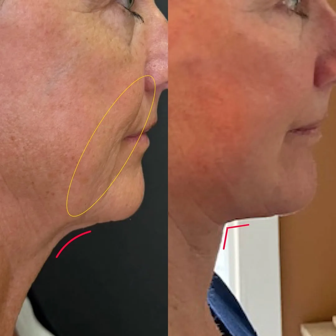 Before and after deep plane facelift — 45-year-old man, left profile view, 6mo post-op by Dr. Sean Hashemi