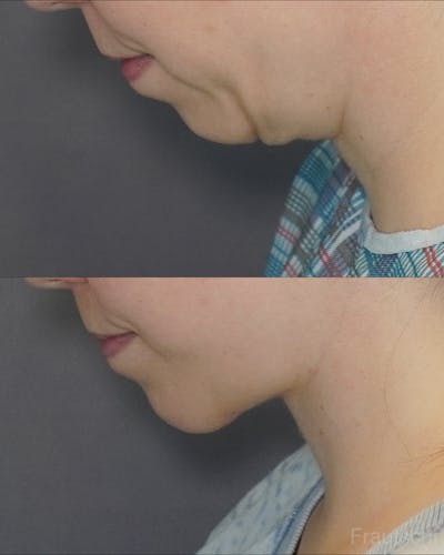 Before deep plane facelift — 28-year-old woman, frontal view, 3mo post-op by Dr. Sean Paul