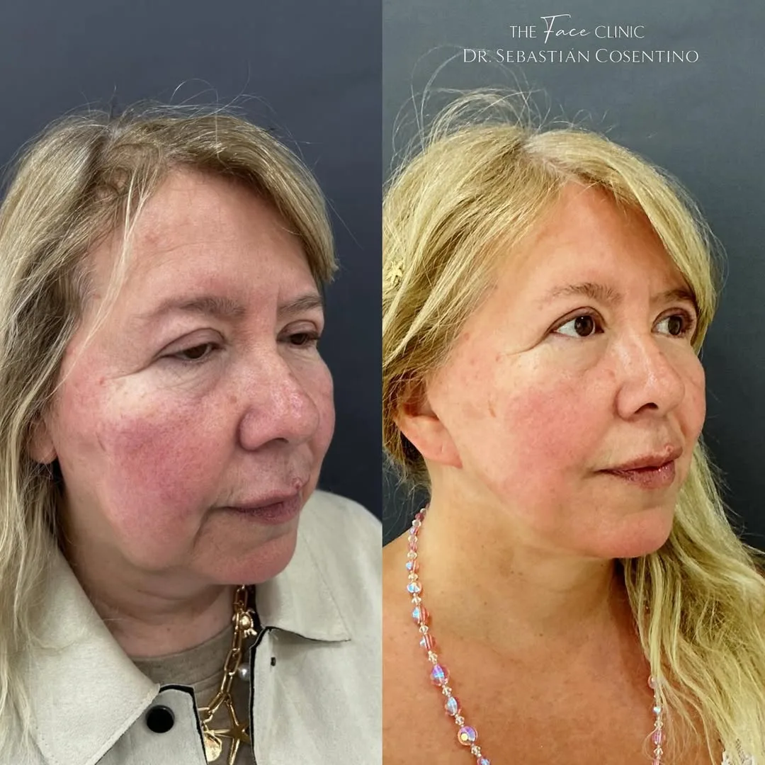 Before and after — Dr. Sebastián Cosentino