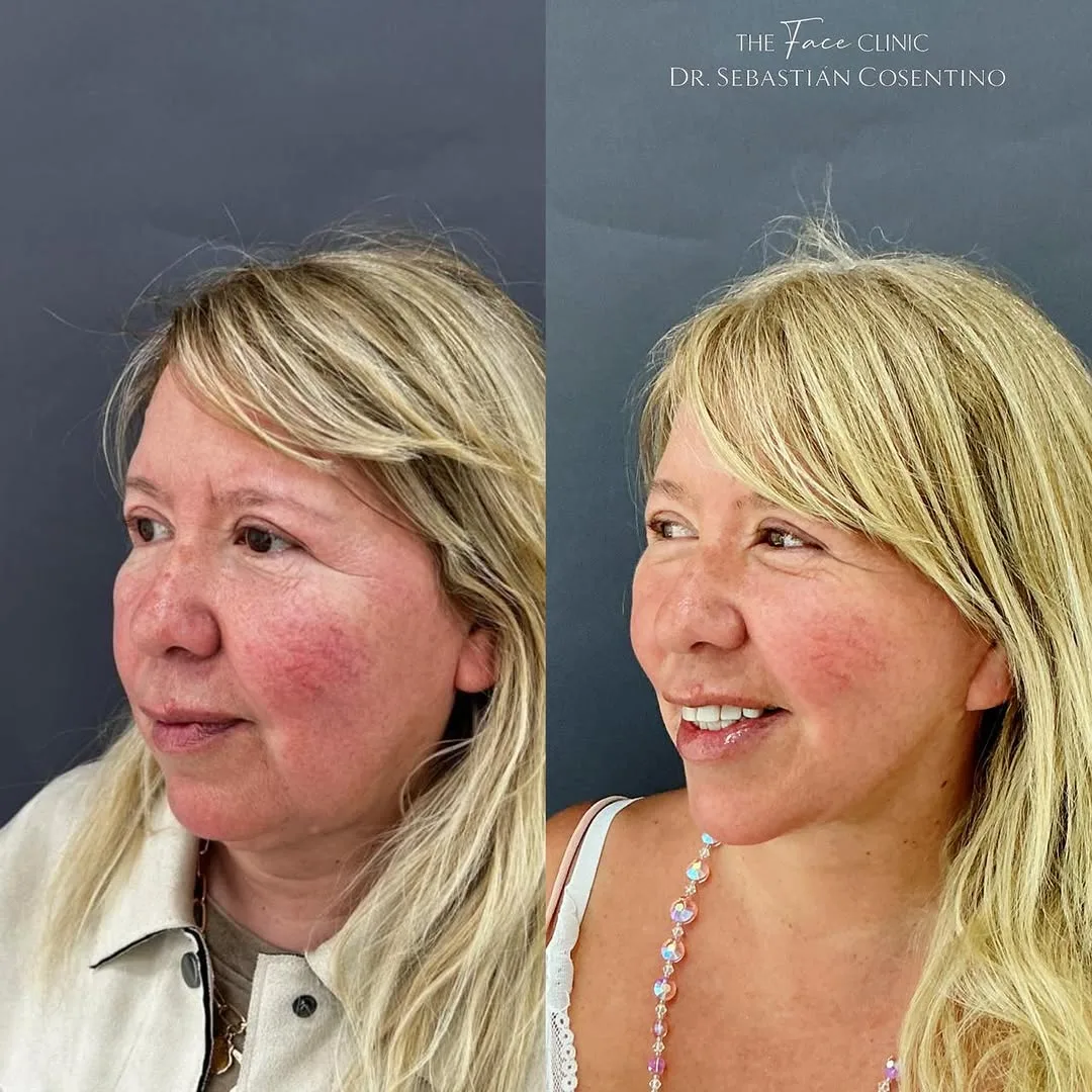 Before and after — Dr. Sebastián Cosentino