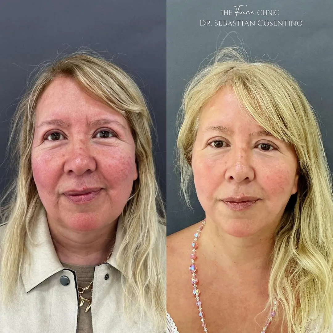 Before and after — Dr. Sebastián Cosentino