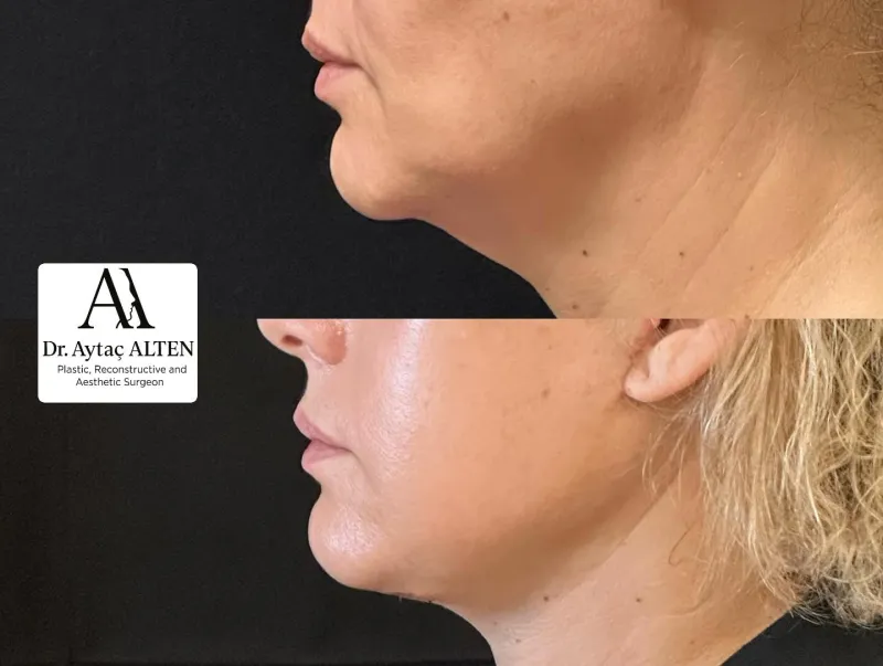 Before and after — Dr. Selçuk Aytaç