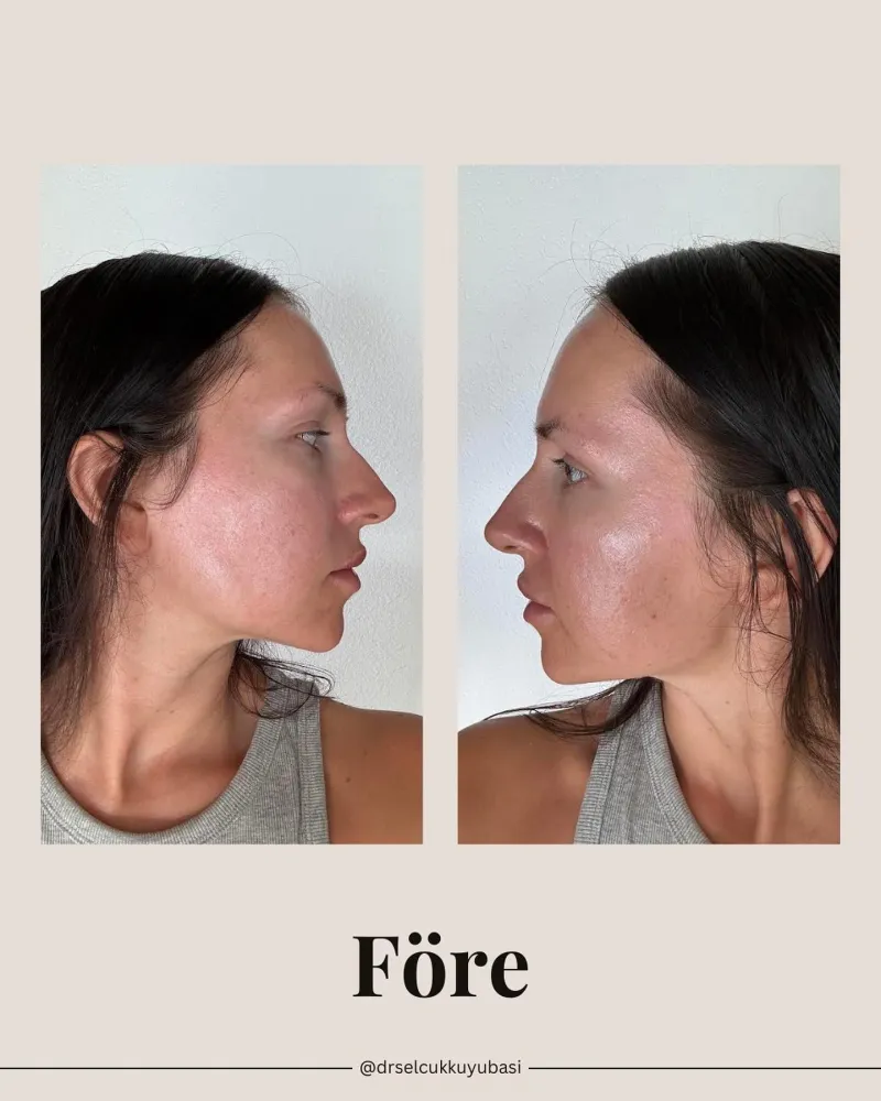 Before and after — Dr. Selçuk Kuyubaşı
