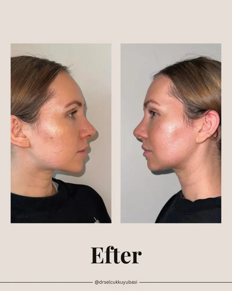 Before and after — Dr. Selçuk Kuyubaşı