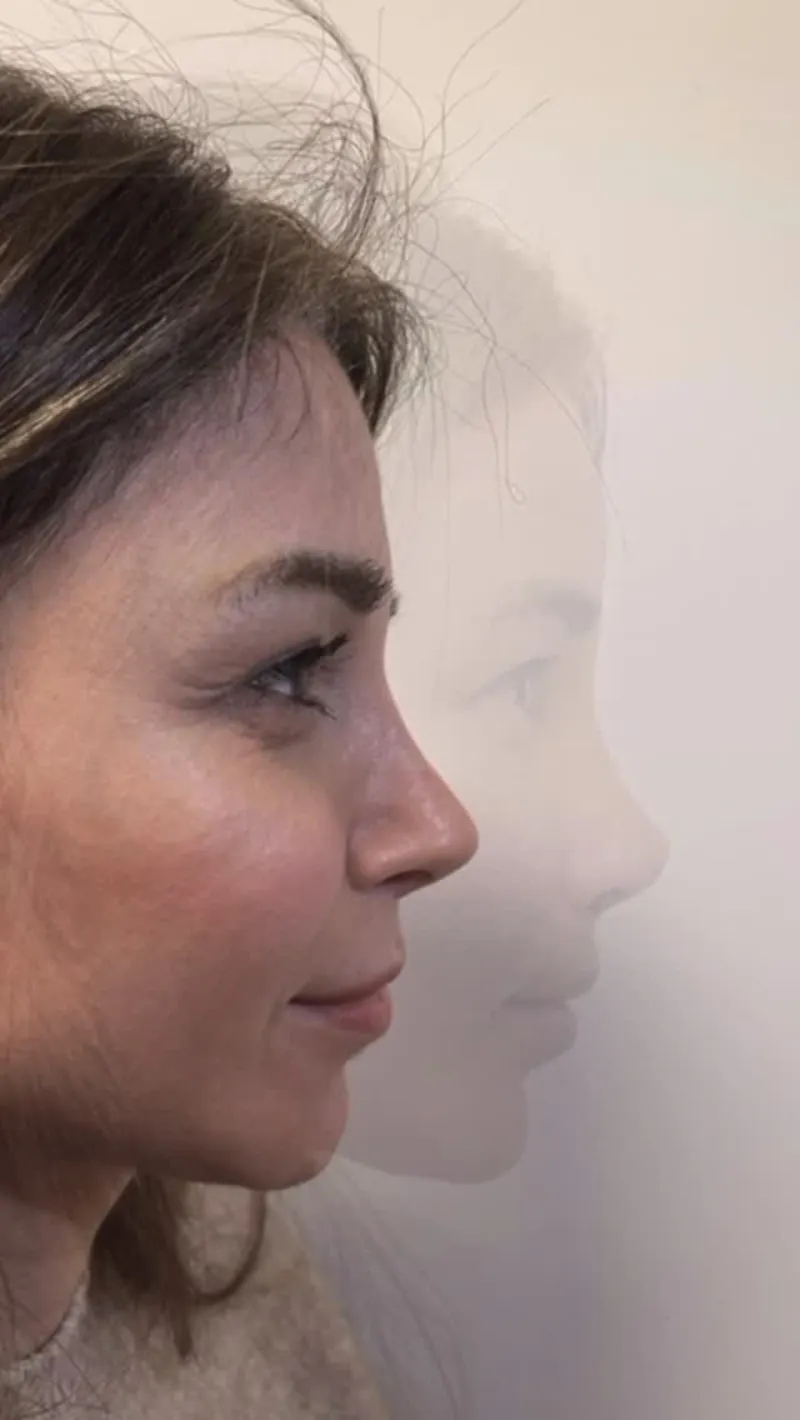 Before and after — Dr. Selçuk Yazan