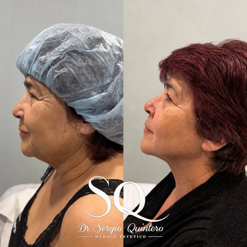 Before and after — Dr. Sergio Quintero