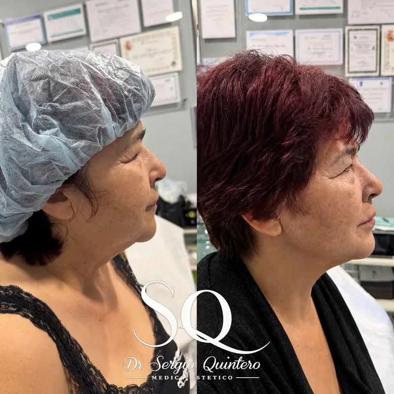 Before and after — Dr. Sergio Quintero