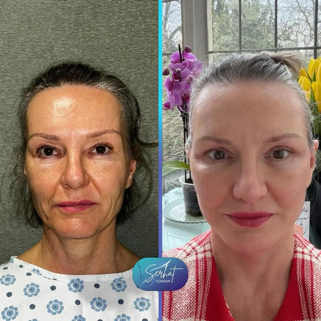 Before and after deep plane facelift — 55-year-old woman, frontal view, 6mo post-op by Dr. Serhat Dündar
