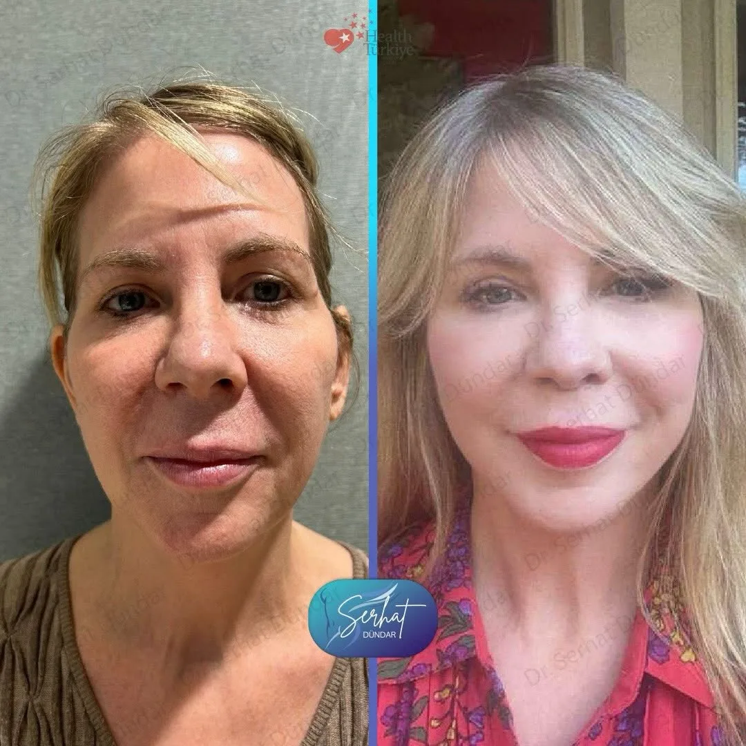 Before and after deep plane facelift — 55-year-old woman, frontal view, 9mo post-op by Dr. Serhat Dündar