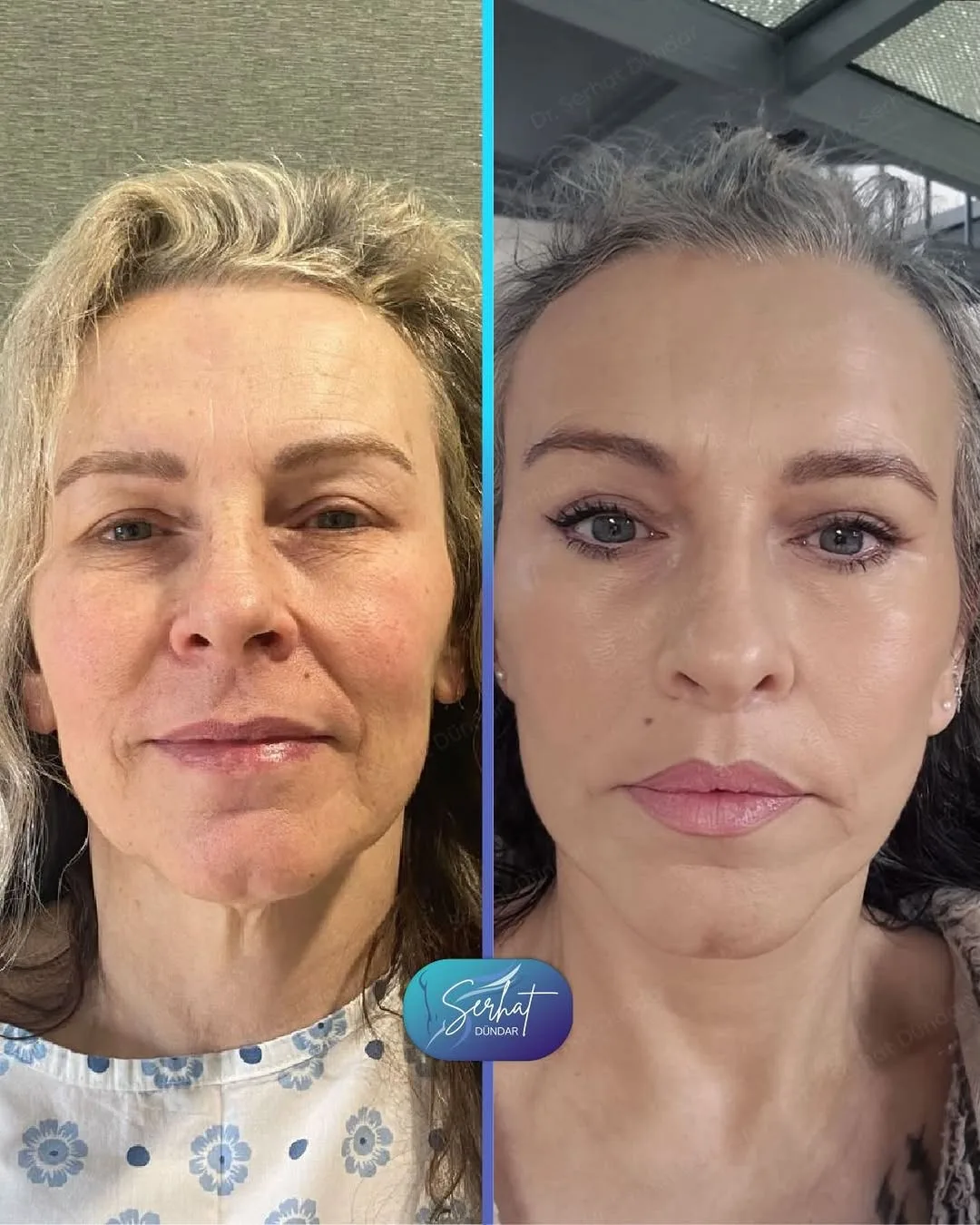 Before and after deep plane facelift — 48-year-old woman, frontal view, 6mo post-op by Dr. Serhat Dündar