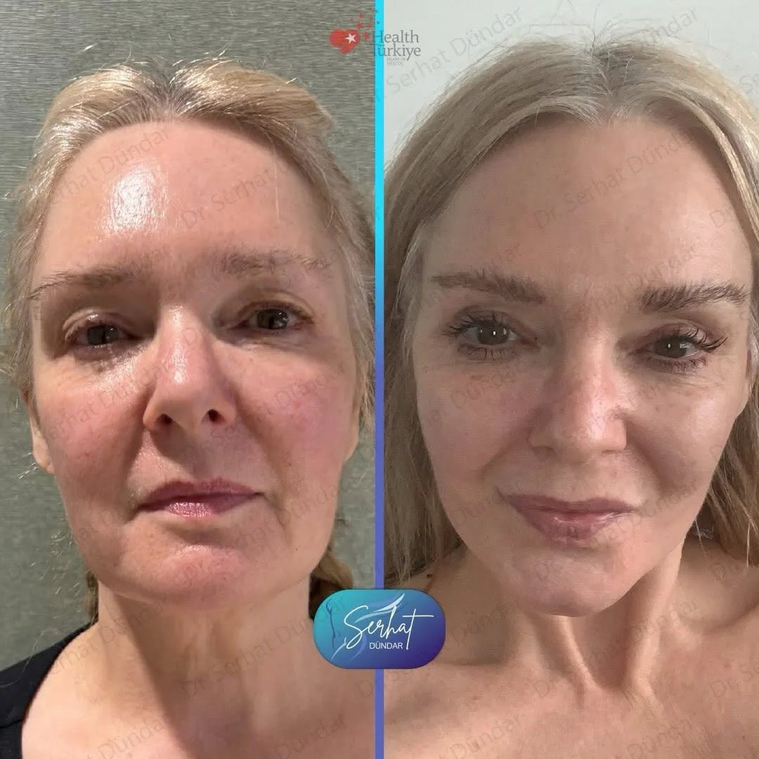 Before and after deep plane facelift — 52-year-old woman, frontal view, 6mo post-op by Dr. Serhat Dündar