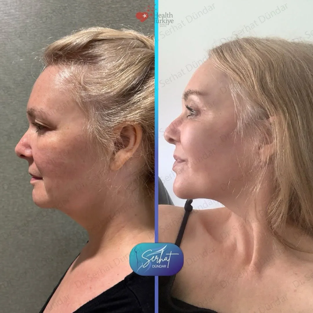 Before and after deep plane facelift — 48-year-old woman, right profile view, 6mo post-op by Dr. Serhat Dündar
