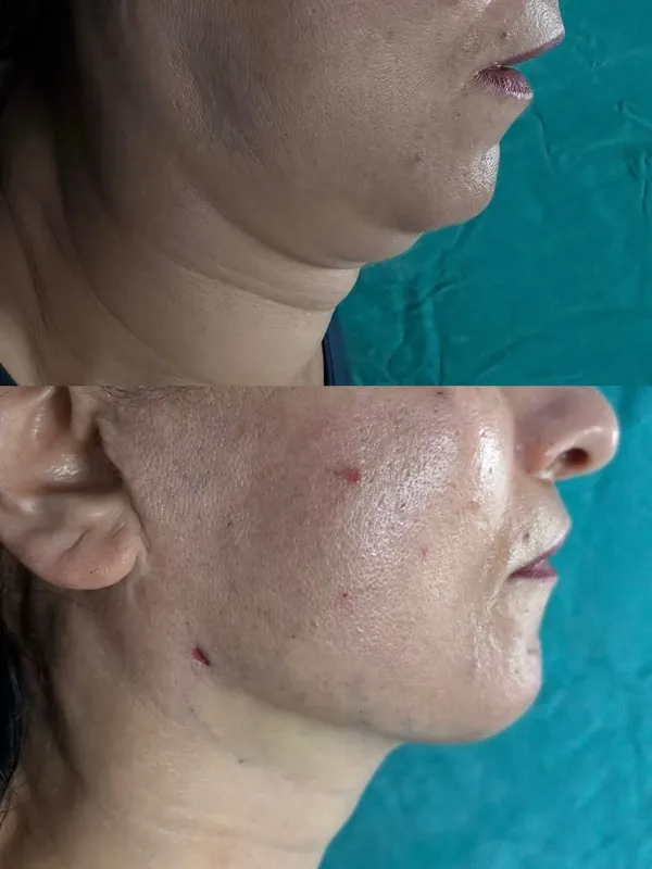 Before and after deep plane facelift — -1-year-old patient, frontal view by Dr. Sezgin Kurt