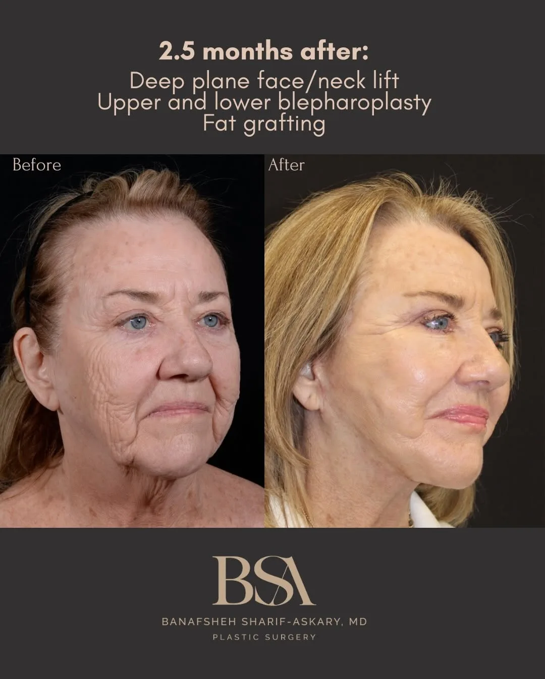 Before and after deep plane facelift — 62-year-old woman, oblique right view, 3mo post-op by Dr. Sharif Askary