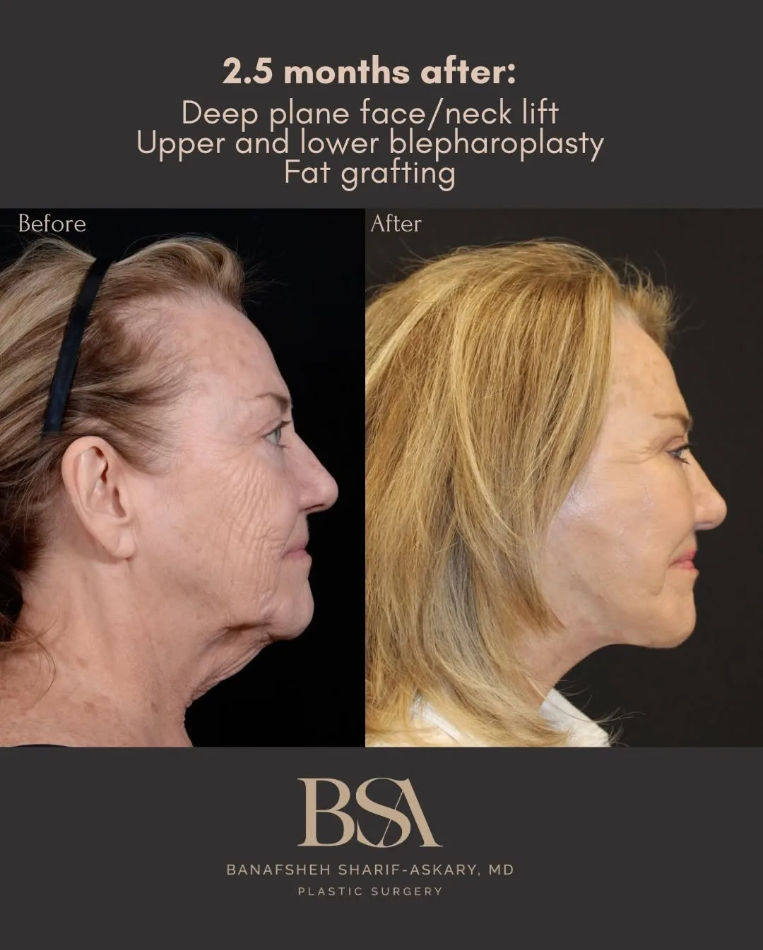 Before and after deep plane facelift — 58-year-old woman, right profile view, 3mo post-op by Dr. Sharif Askary