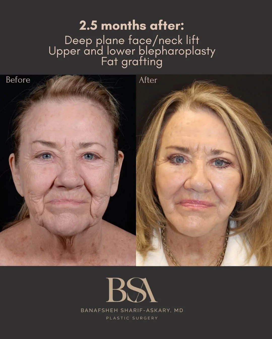 Before and after deep plane facelift — 65-year-old woman, frontal view, 3mo post-op by Dr. Sharif Askary