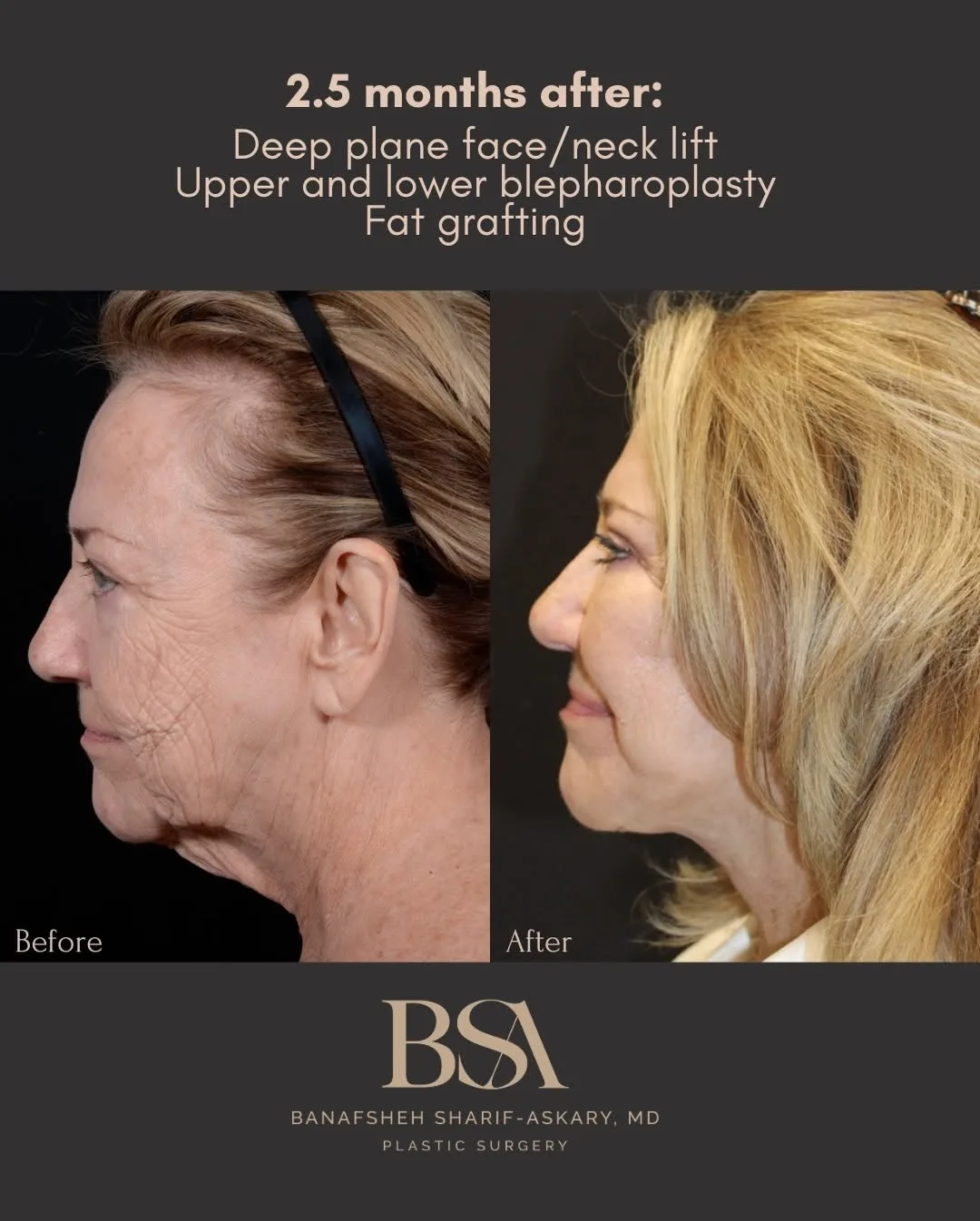 Before and after deep plane facelift — 58-year-old woman, right profile view, 3mo post-op by Dr. Sharif Askary