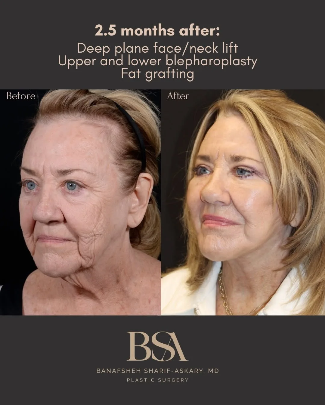 Before and after deep plane facelift — 58-year-old woman, oblique right view, 3mo post-op by Dr. Sharif Askary
