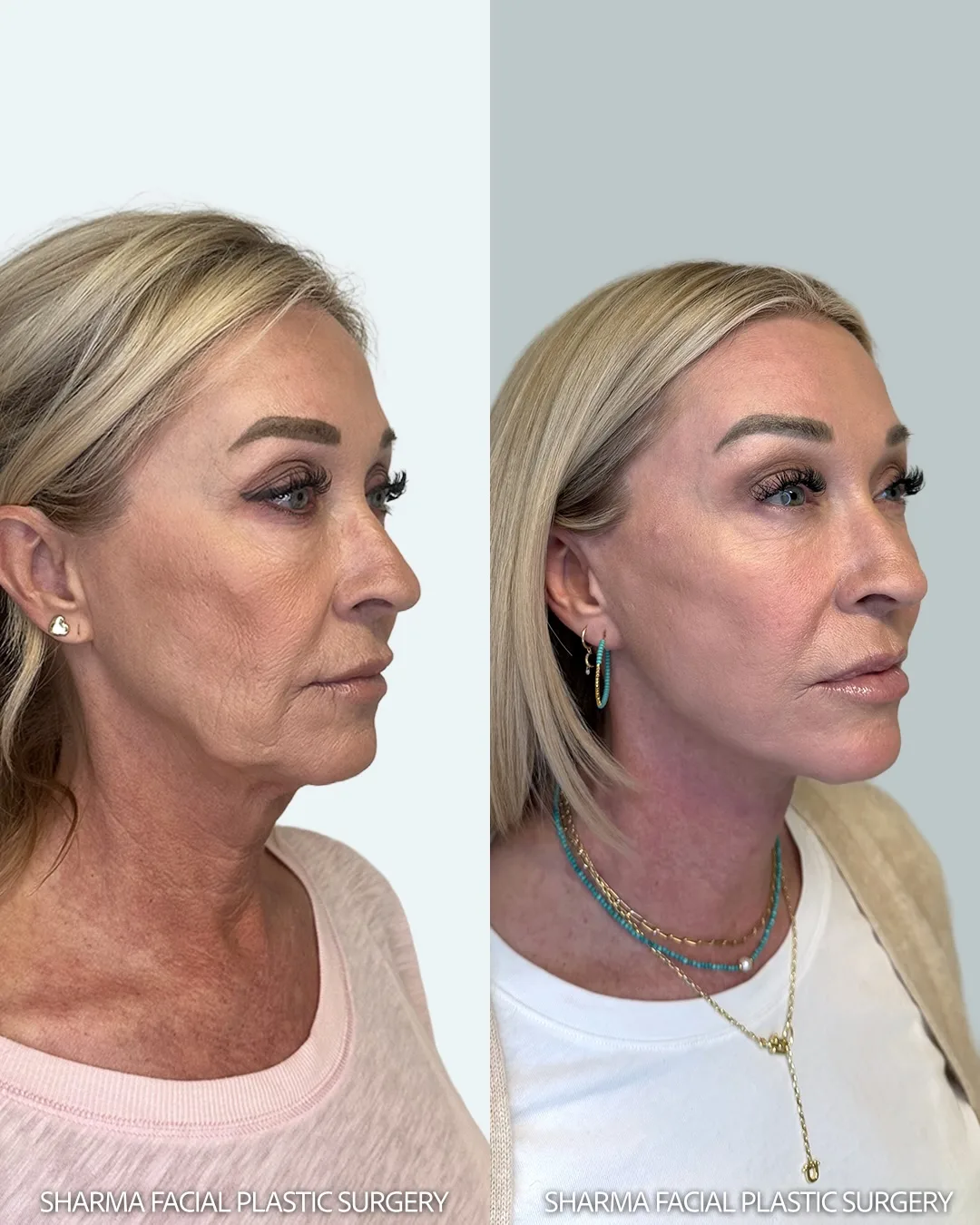 Before and after — Dr. Giriraj Sharma