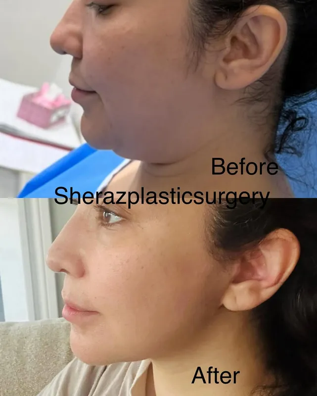 Before and after — Dr. Sheraz Raza
