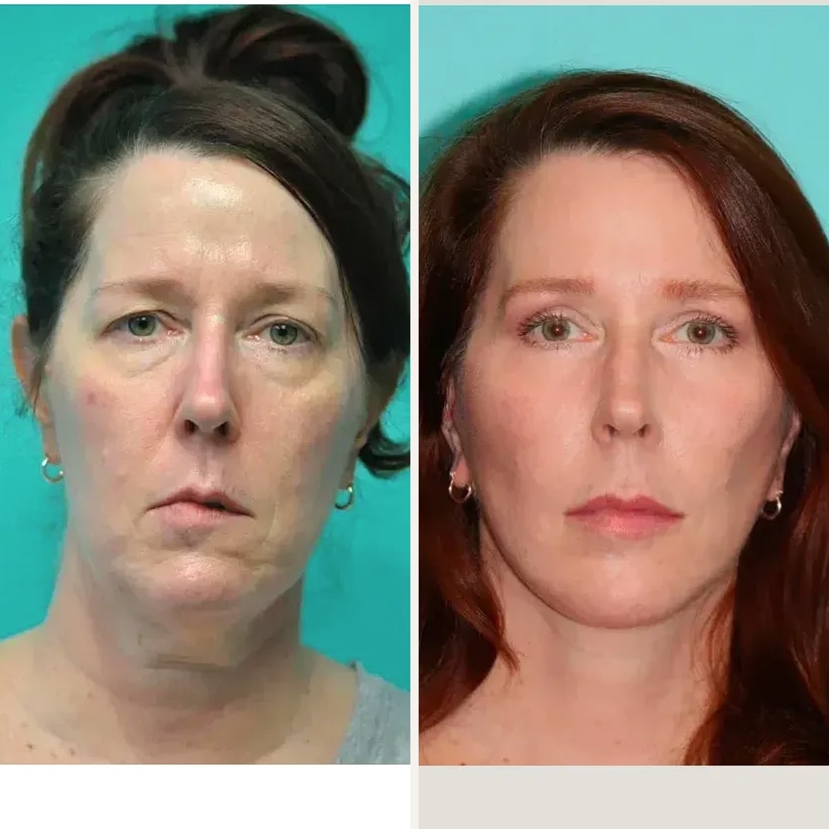До и после — Deep Plane Facelift от доктора Shervin Naderi