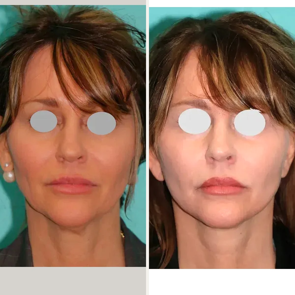 До и после — Deep Plane Facelift от доктора Shervin Naderi