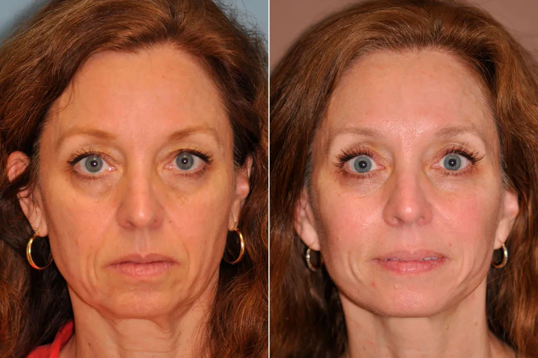 До и после — Deep Plane Facelift от доктора Shervin Naderi