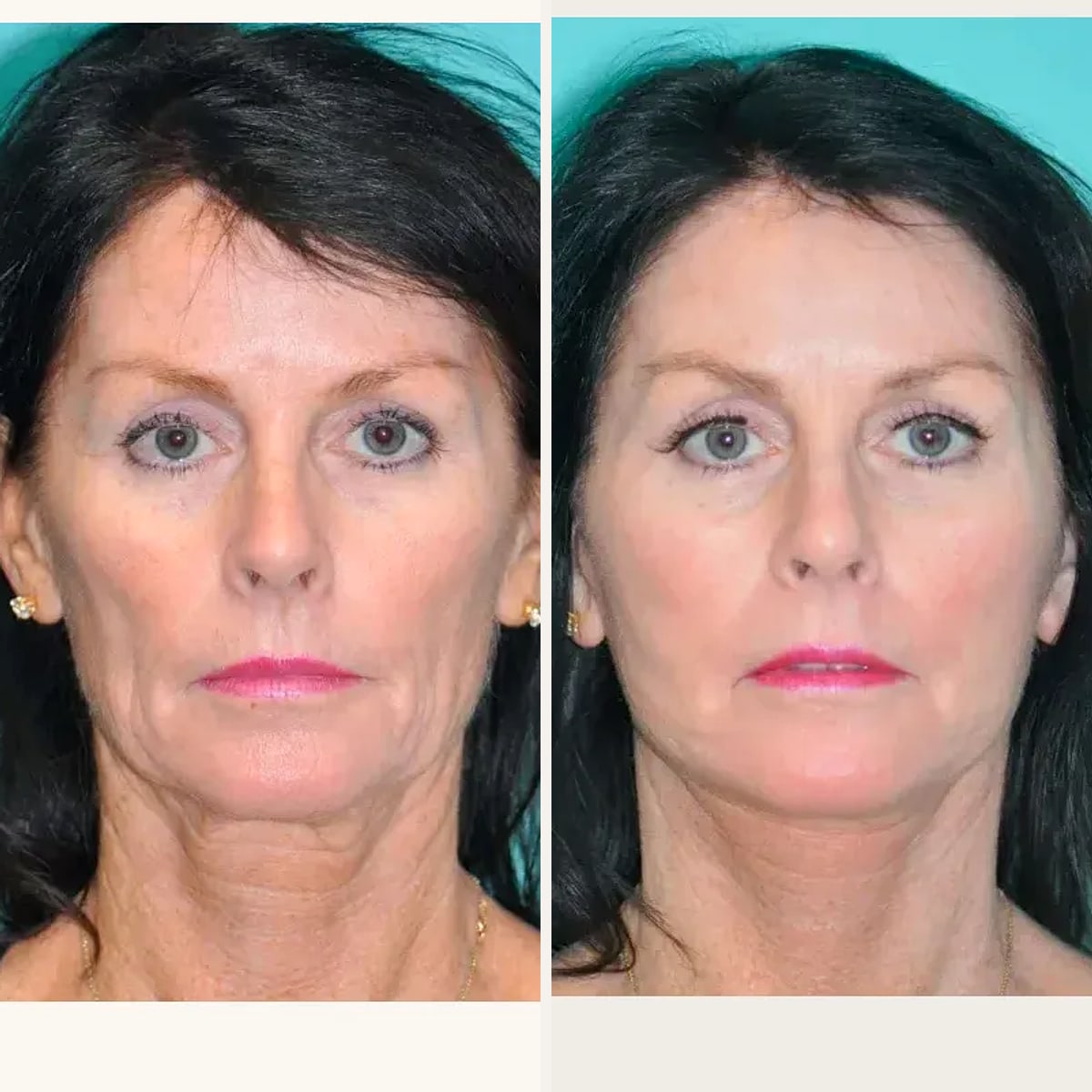 До и после — Deep Plane Facelift от доктора Shervin Naderi
