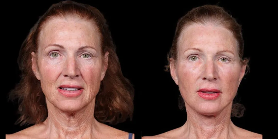 Before and after deep plane facelift — 58-year-old woman, frontal view, 7mo post-op by Dr. Shim Ching