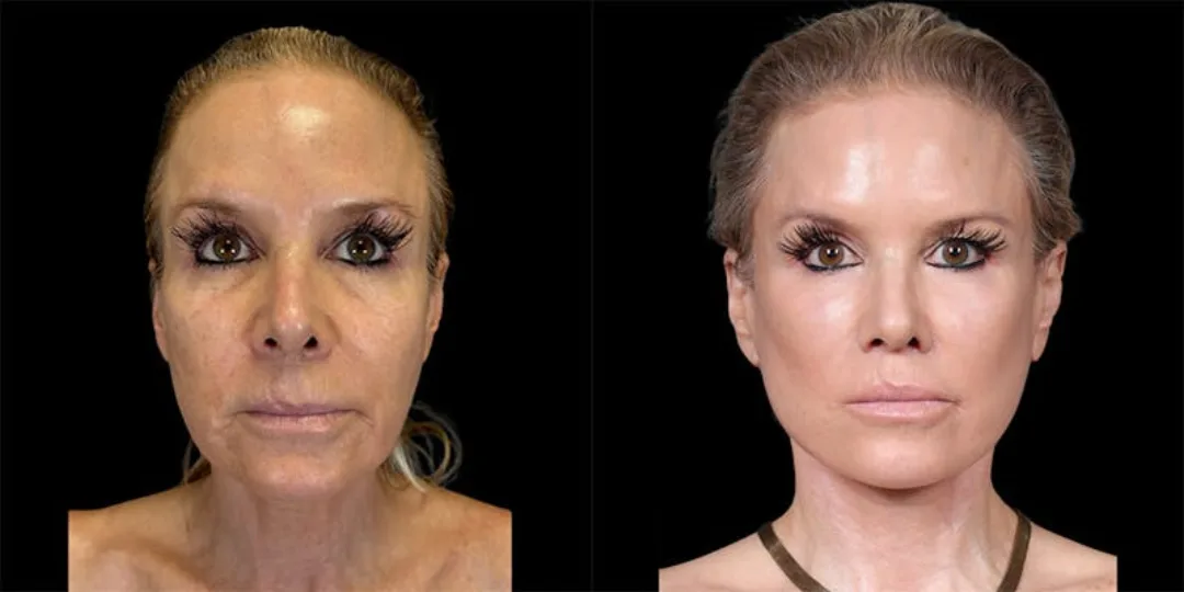 Before and after deep plane facelift — 55-year-old woman, frontal view, 7mo post-op by Dr. Shim Ching