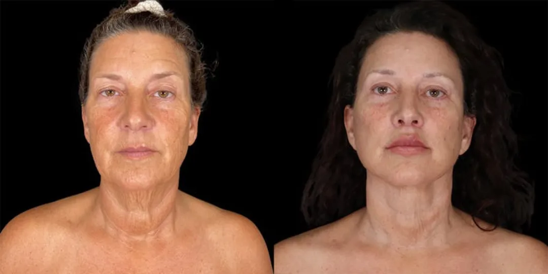 Before and after deep plane facelift — 58-year-old woman, frontal view, 7mo post-op by Dr. Shim Ching