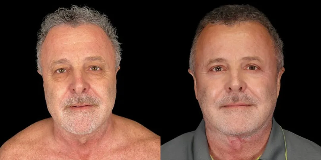 Before and after deep plane facelift — 58-year-old man, frontal view, 7mo post-op by Dr. Shim Ching