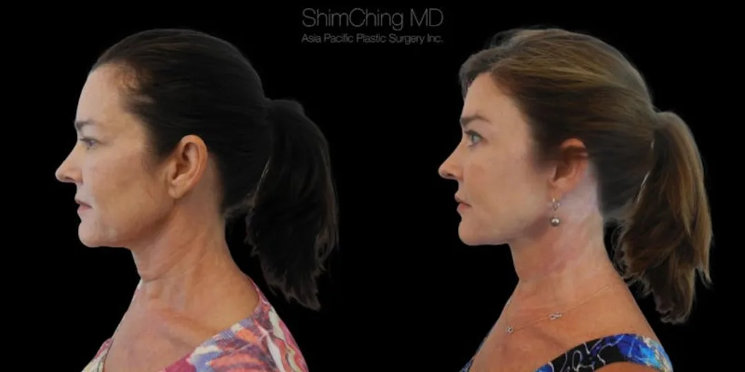 Before and after deep plane facelift — 50-year-old woman, right profile view, 6mo post-op by Dr. Shim Ching