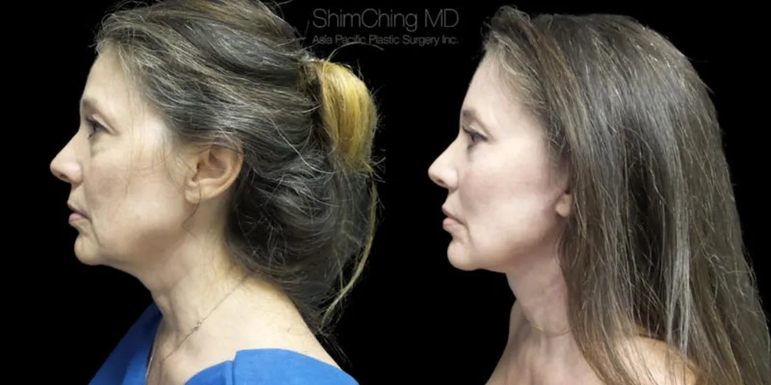 Before and after deep plane facelift — 55-year-old woman, left profile view, 9mo post-op by Dr. Shim Ching