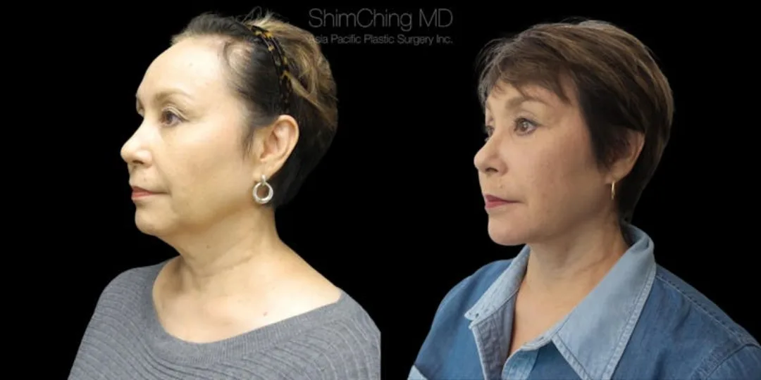 Before and after deep plane facelift — 58-year-old woman, right profile view, 6mo post-op by Dr. Shim Ching