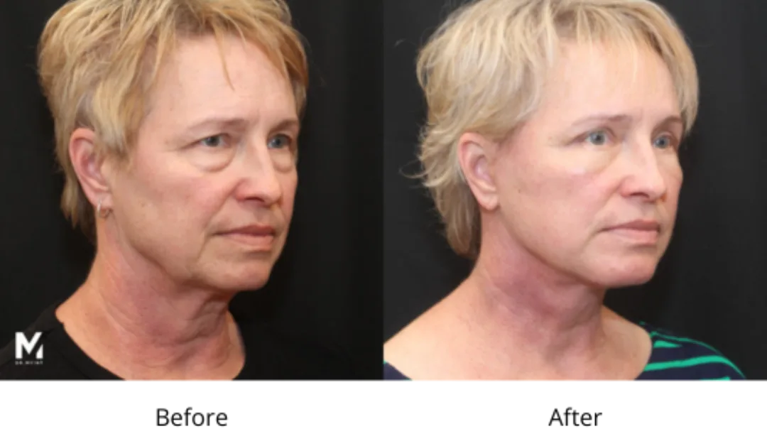 Before and after — Dr. Shoib Myint