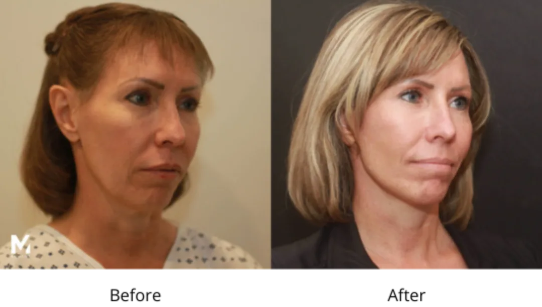Before and after — Dr. Shoib Myint